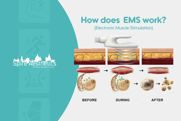 EMS treatment for post pregnancy weight loss treatment Leamington Spa