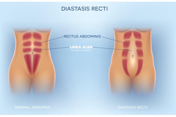 What Non-Surgical Options Are Available for Diastasis Recti Leamington Spa?