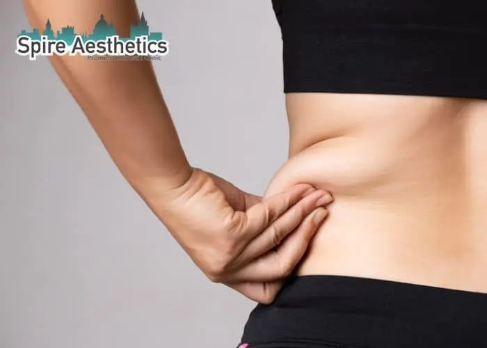 Image of woman pinching fat on their hips Leamington Spa. Fat Freezing treatment