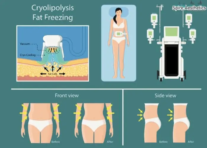 Fat freezing treatment Leamington Spa benefits for competitions to remove stubborn fat deposits.