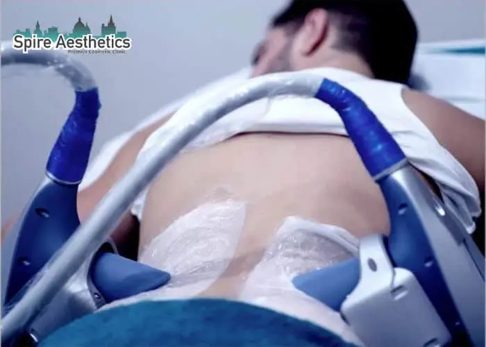 Man having fat freezing treatment done on love handles before a competitions Leamington Spa to create a sculpted look.