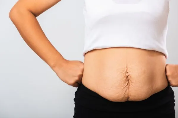 Image of a woman's stomach after weight loss with sagging skin following a gastric band Leamington Spa