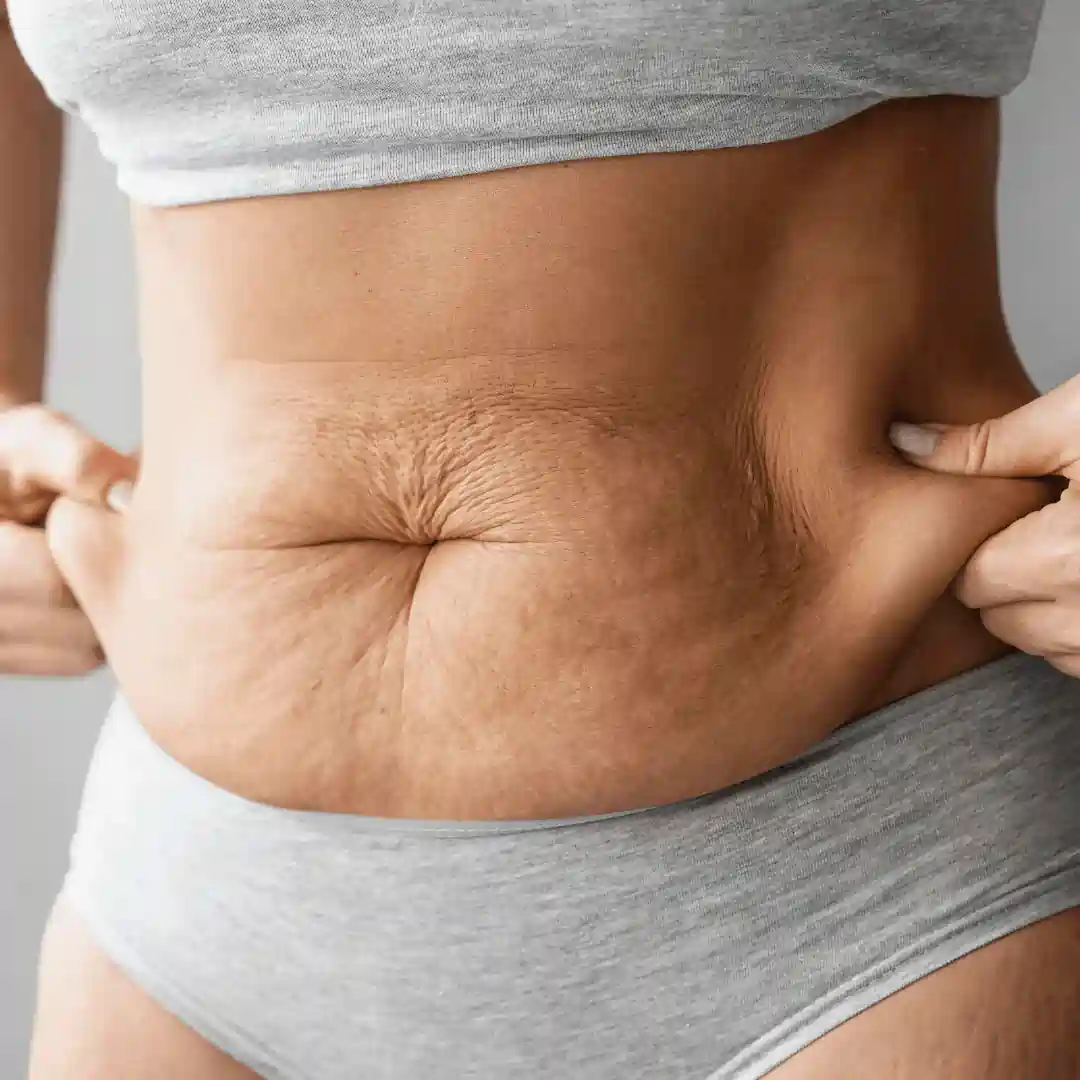 Is It Normal to Have Loose Skin After Pregnancy Leamington Spa?
