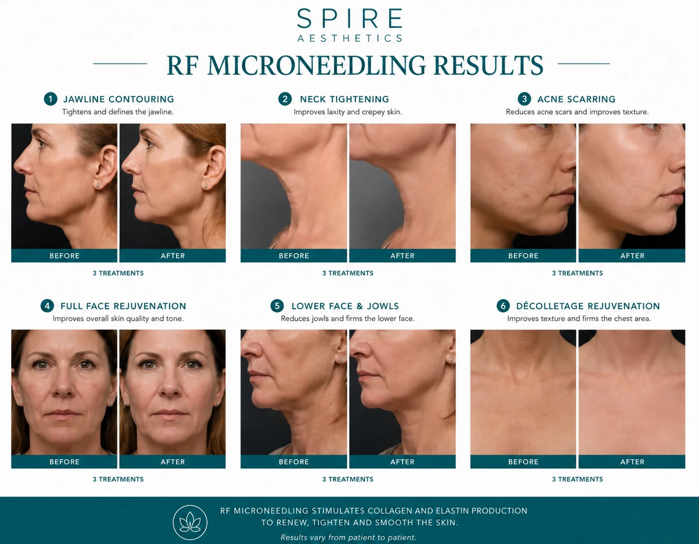 RF Microneedling Skin tightening Leamington Spa results