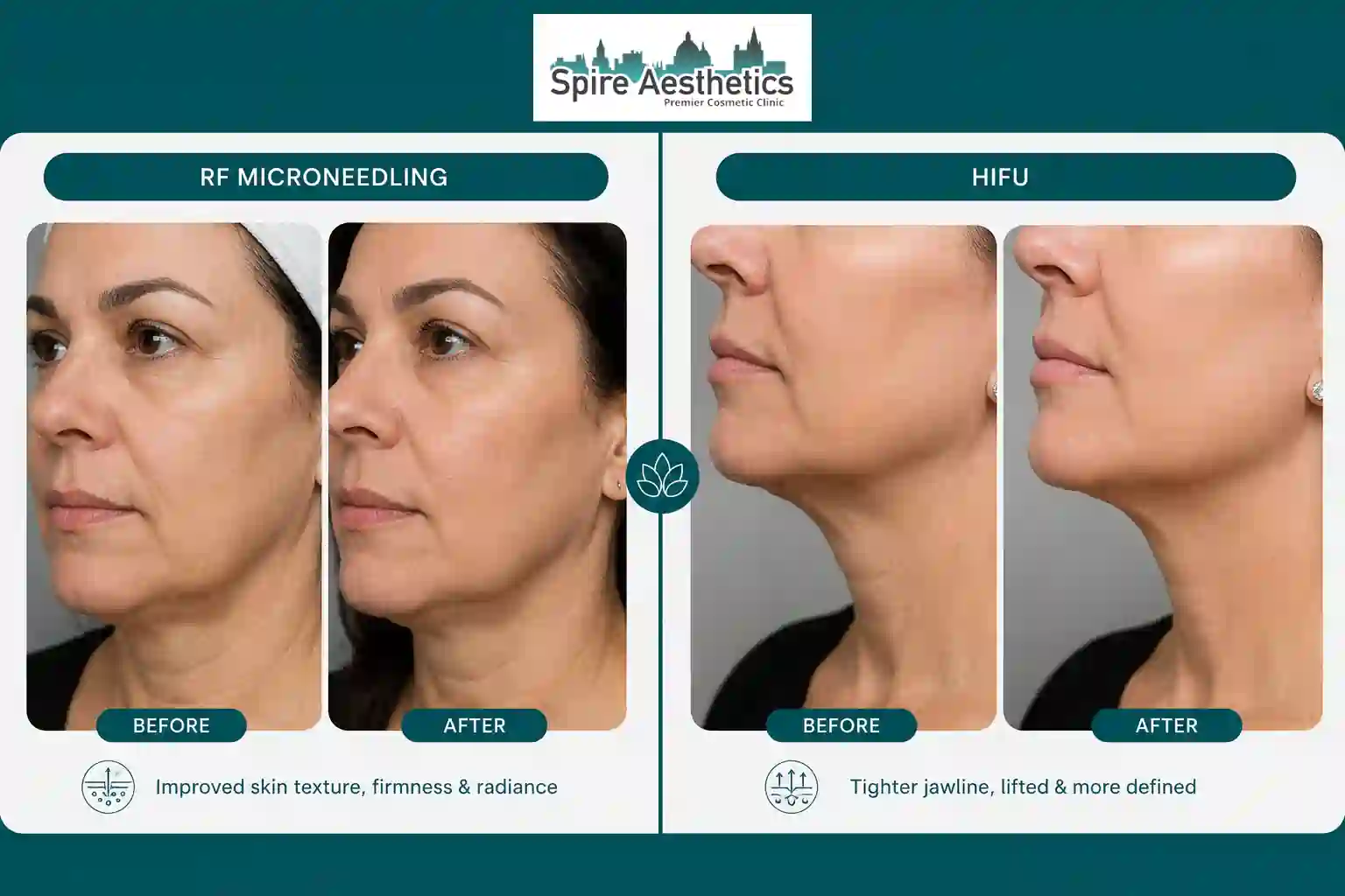 Can RF Microneedling and HIFU Be Combined Leamington Spa?