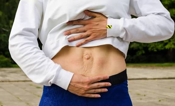 When Could Diastasis Recti Be the Missing Piece of the Puzzle Leamington Spa?