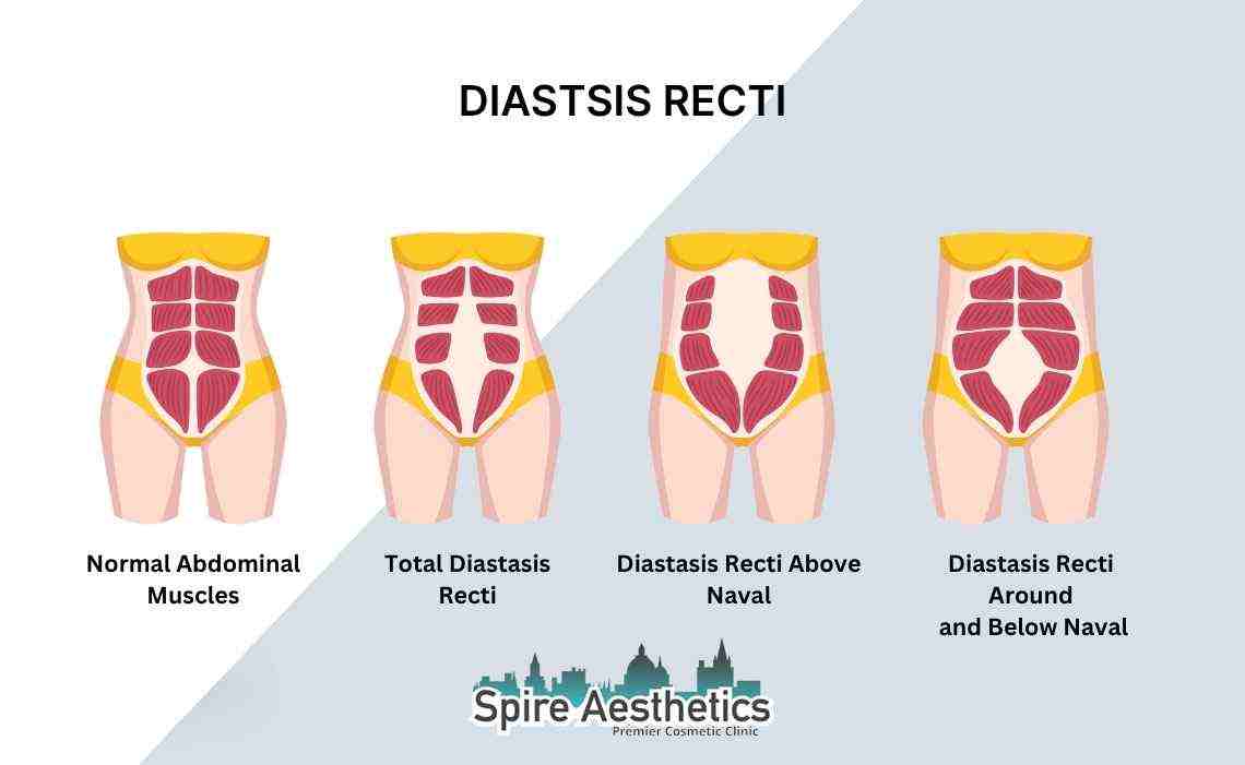 Is Non-Surgical Diastasis Recti Treatment Right for You? Common Concerns Answered Leamington Spa